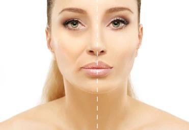 Dermal Fillers Nasobial